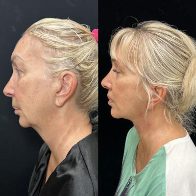 Deep Plane Facelift Before & After Gallery - Patient 299101 - Image 5
