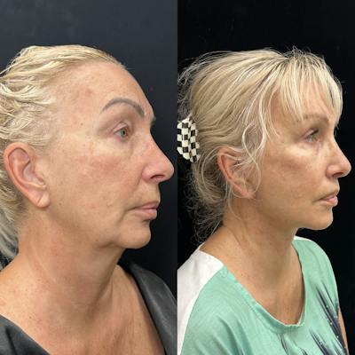 Deep Plane Facelift Before & After Gallery - Patient 299101 - Image 2