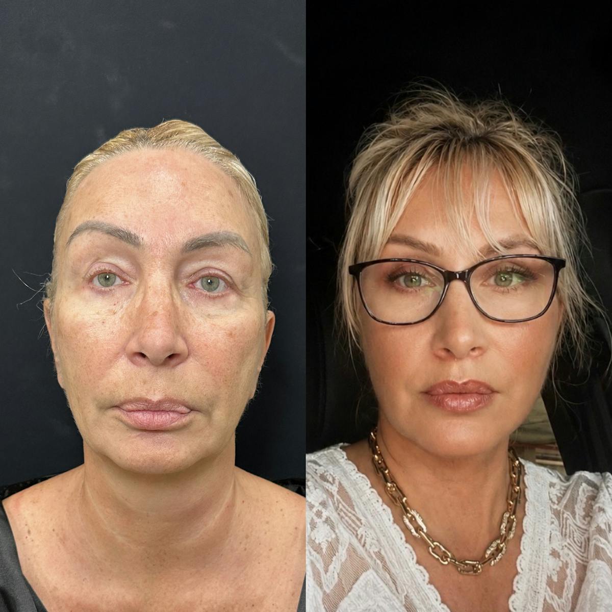 Deep Plane Facelift Before & After Gallery - Patient 299101 - Image 1