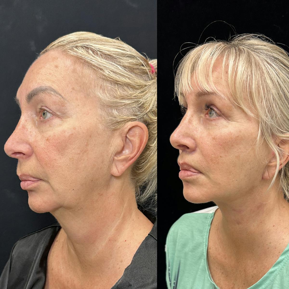 Deep Plane Facelift Before & After Gallery - Patient 299101 - Image 4
