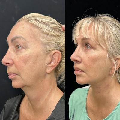 Deep Plane Facelift Before & After Gallery - Patient 299101 - Image 4