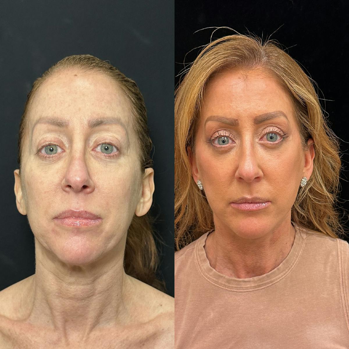 Deep Plane Facelift Before & After Gallery - Patient 162804 - Image 1