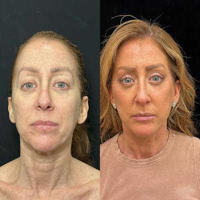 Deep Plane Facelift Before & After Gallery - Patient 162804 - Image 1