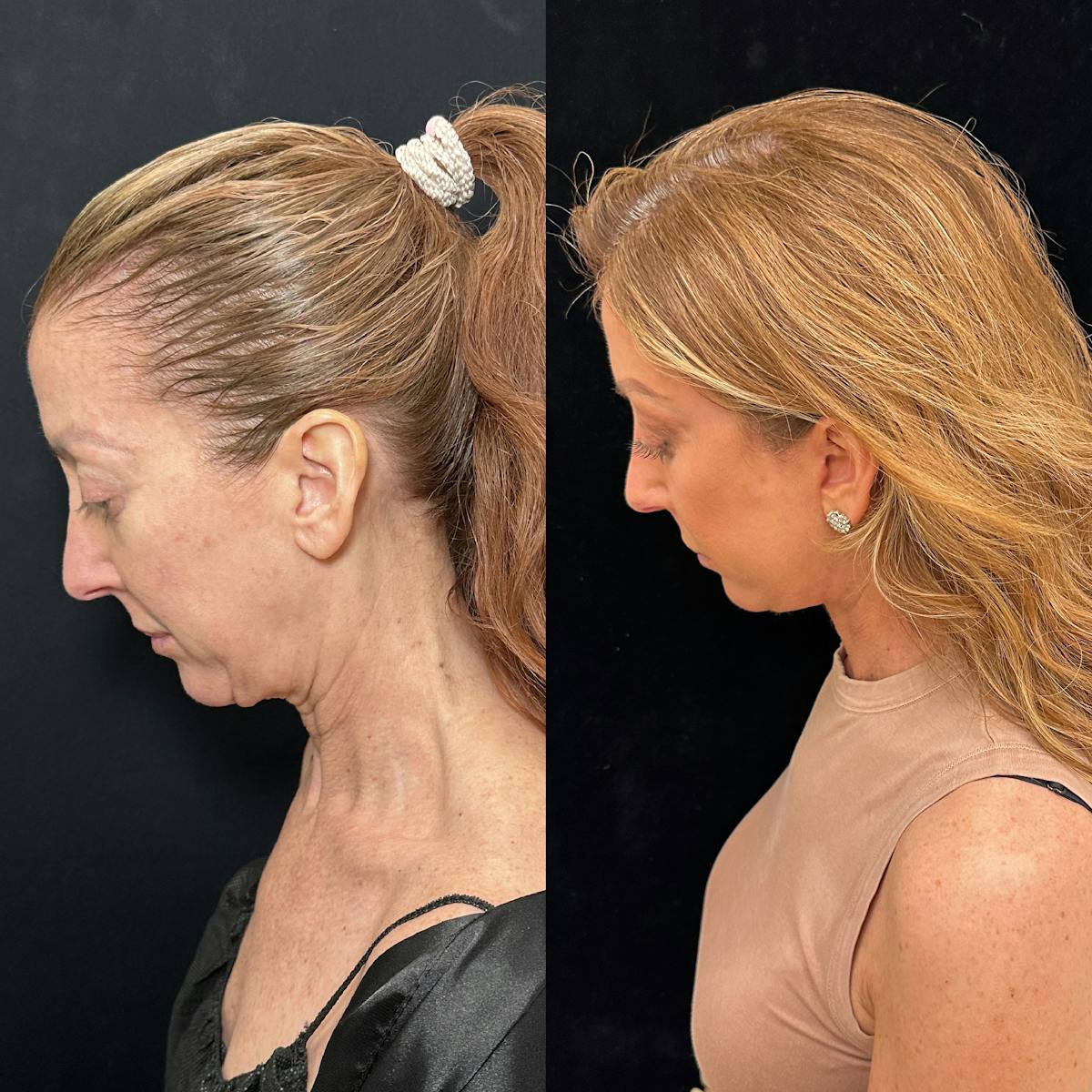 Deep Plane Facelift Before & After Gallery - Patient 162804 - Image 7