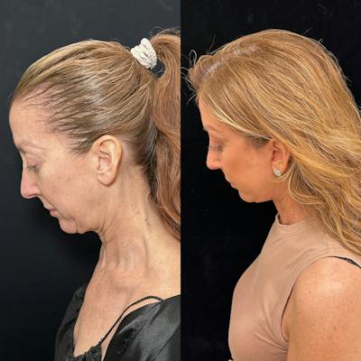 Deep Plane Facelift Before & After Gallery - Patient 162804 - Image 7
