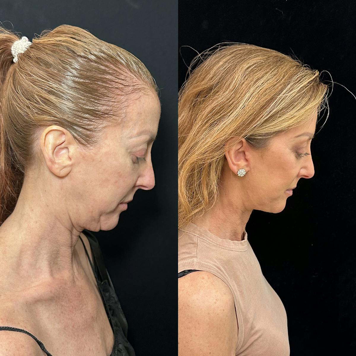 Deep Plane Facelift Before & After Gallery - Patient 162804 - Image 4