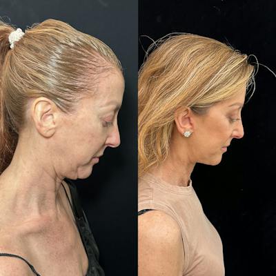 Deep Plane Facelift Before & After Gallery - Patient 162804 - Image 4