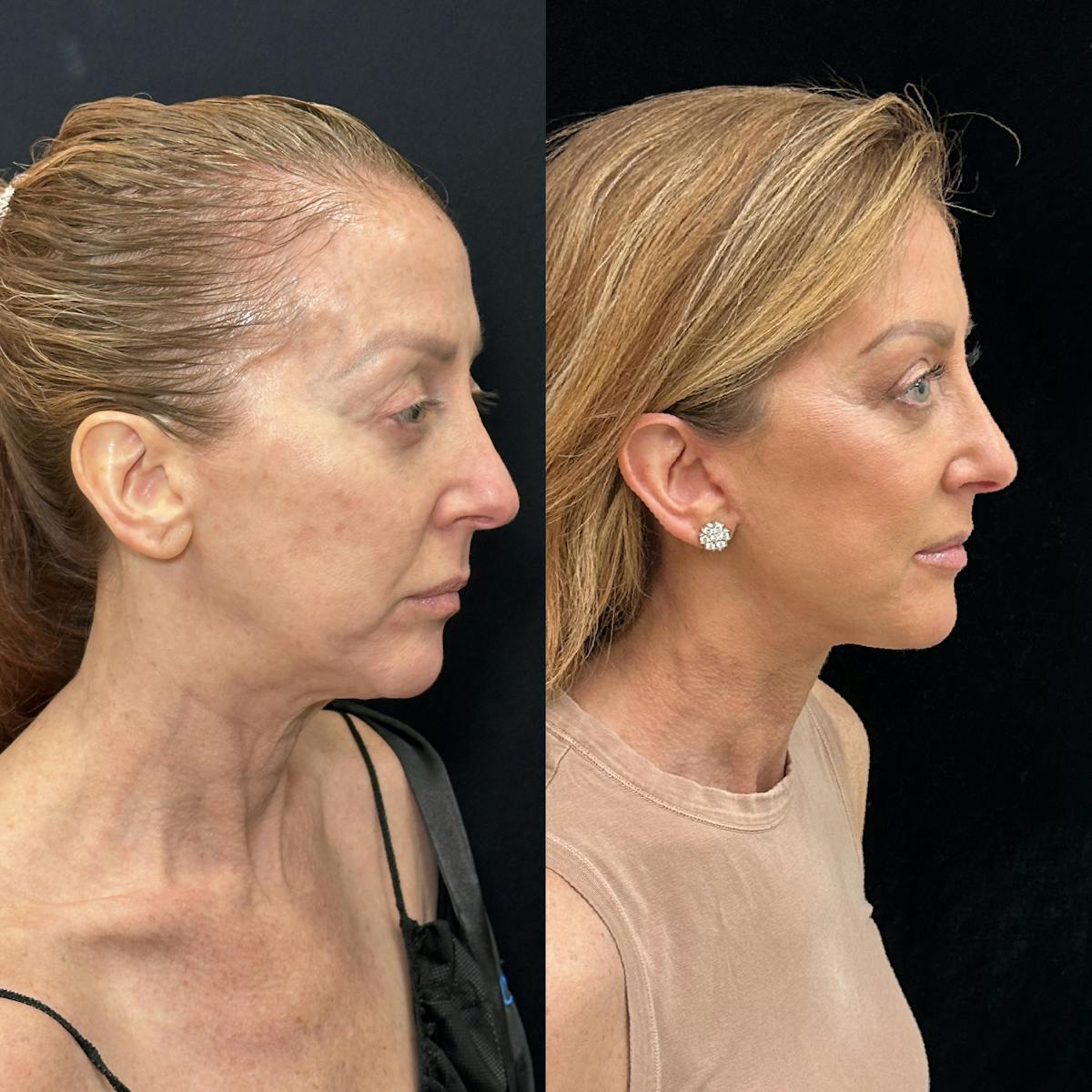 Deep Plane Facelift Before & After Gallery - Patient 162804 - Image 2