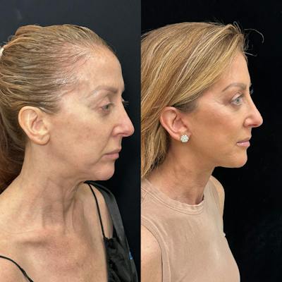 Deep Plane Facelift Before & After Gallery - Patient 162804 - Image 2
