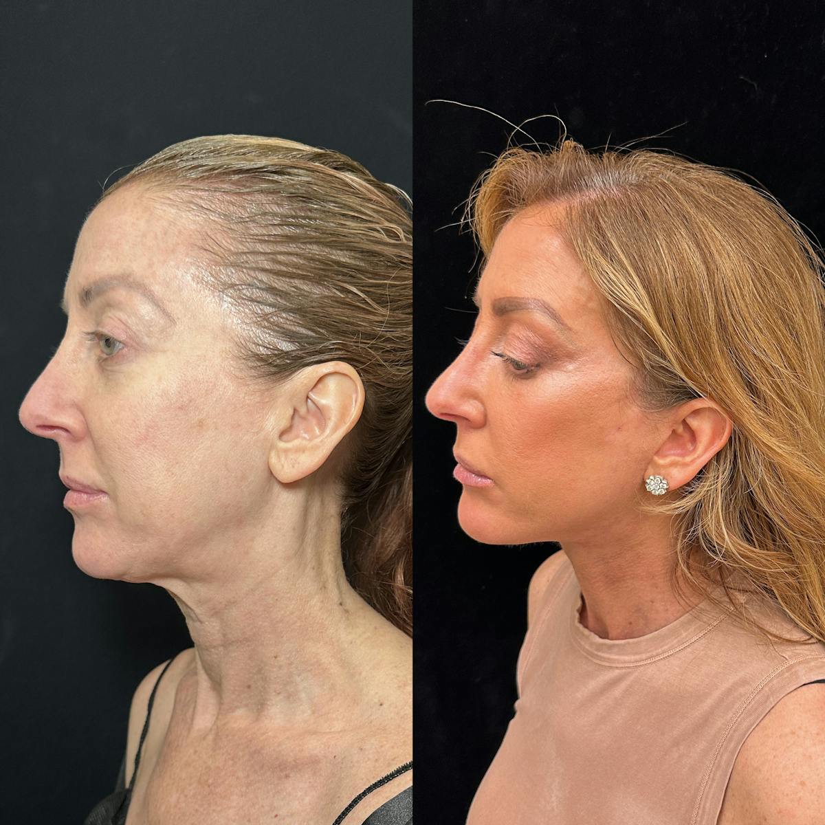 Deep Plane Facelift Before & After Gallery - Patient 162804 - Image 5