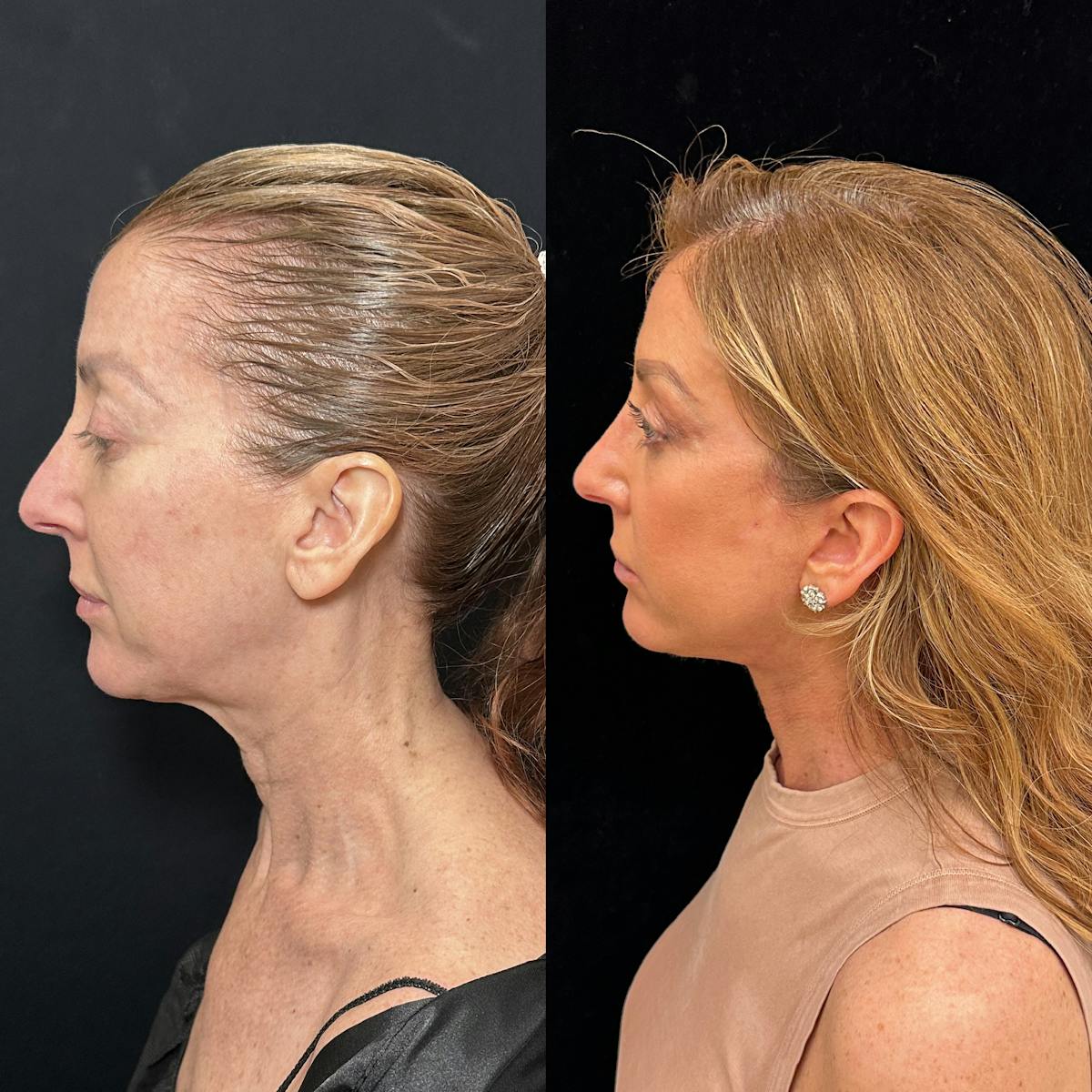 Deep Plane Facelift Before & After Gallery - Patient 162804 - Image 6