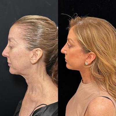 Deep Plane Facelift Before & After Gallery - Patient 162804 - Image 6