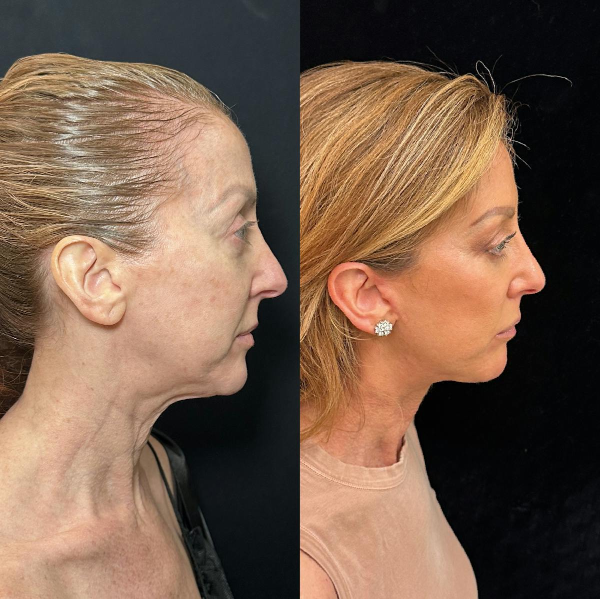 Deep Plane Facelift Before & After Gallery - Patient 162804 - Image 3