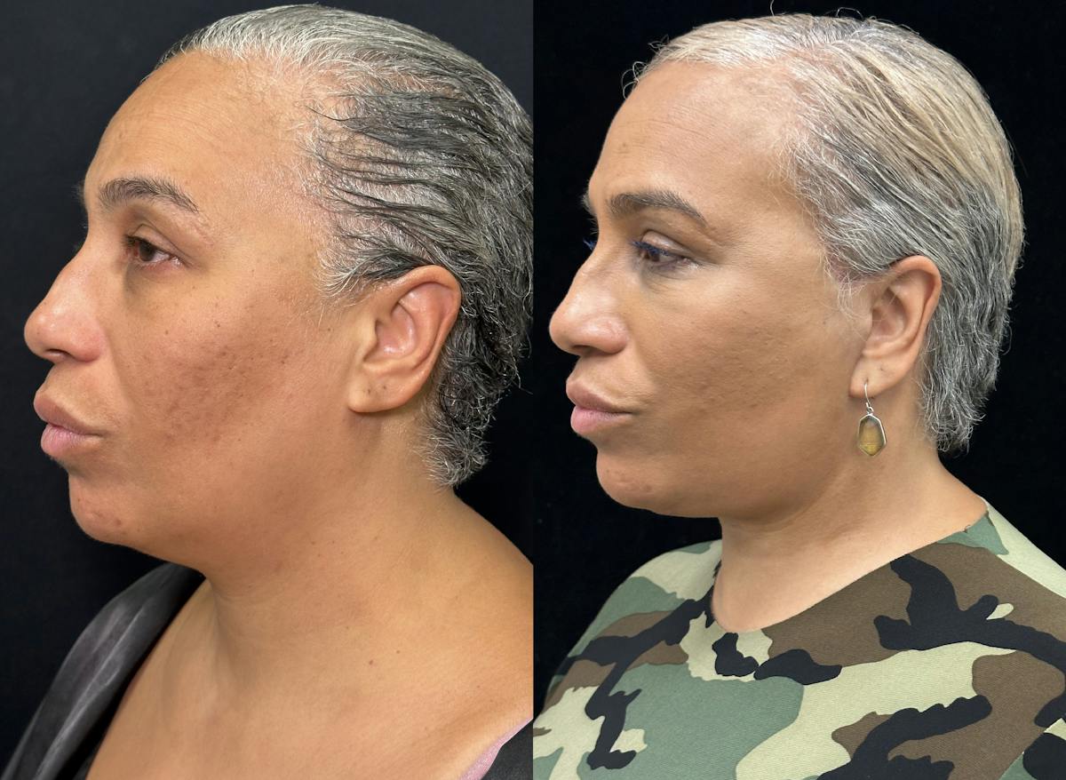 Deep Plane Facelift Before & After Gallery - Patient 165501 - Image 4