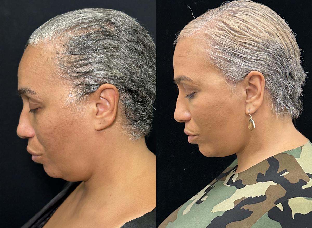 Deep Plane Facelift Before & After Gallery - Patient 165501 - Image 5
