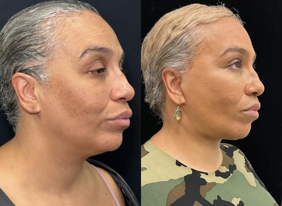 Deep Plane Facelift Before & After Gallery - Patient 165501 - Image 1