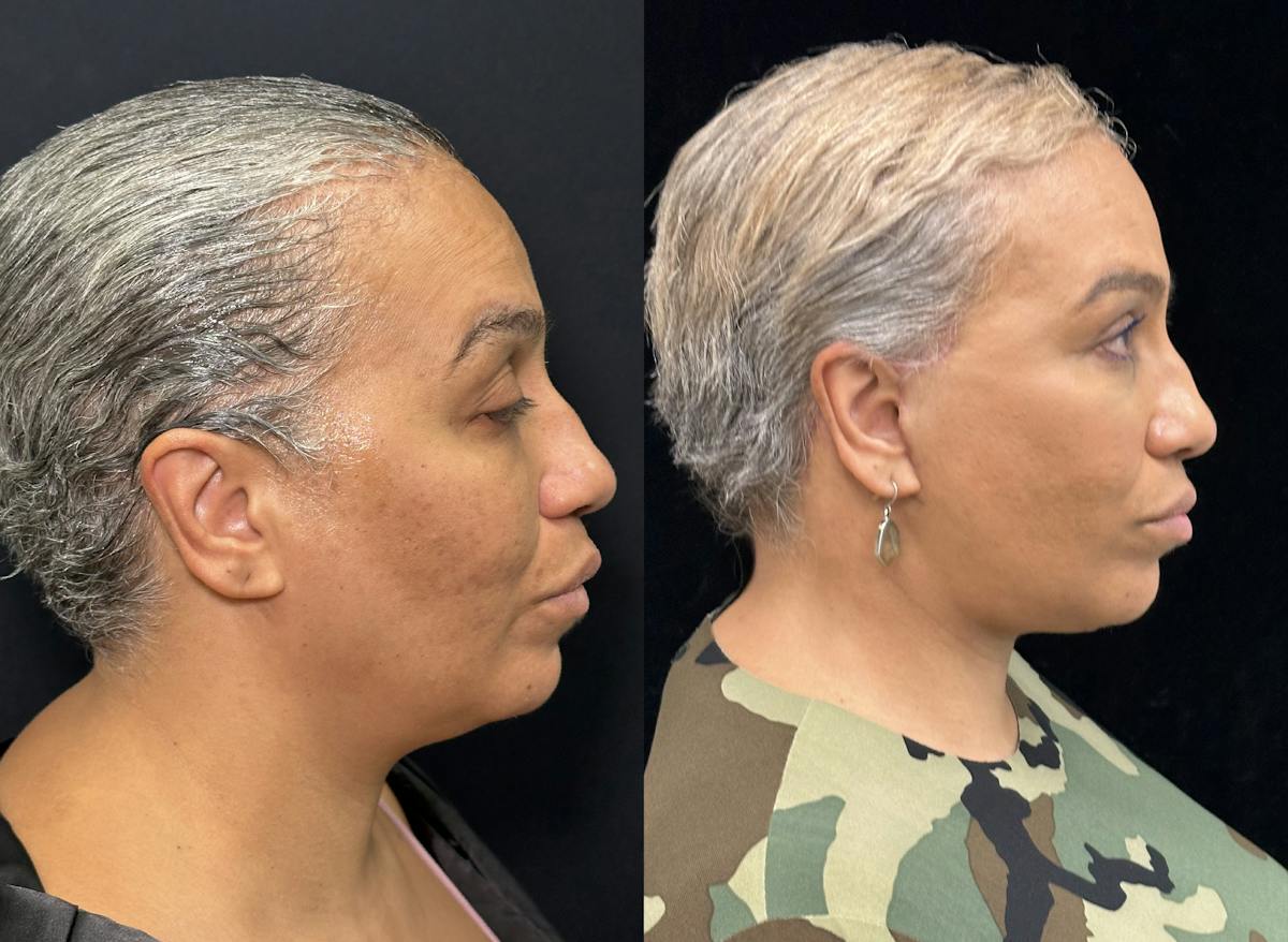 Deep Plane Facelift Before & After Gallery - Patient 165501 - Image 2
