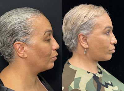 Deep Plane Facelift Before & After Gallery - Patient 165501 - Image 2