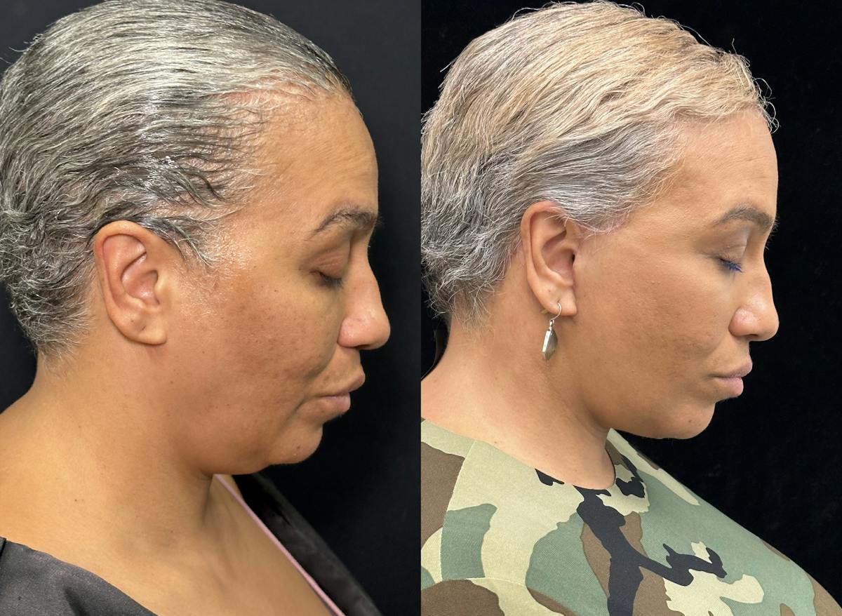 Deep Plane Facelift Before & After Gallery - Patient 165501 - Image 3