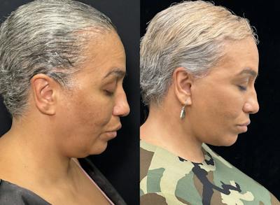 Deep Plane Facelift Before & After Gallery - Patient 165501 - Image 3