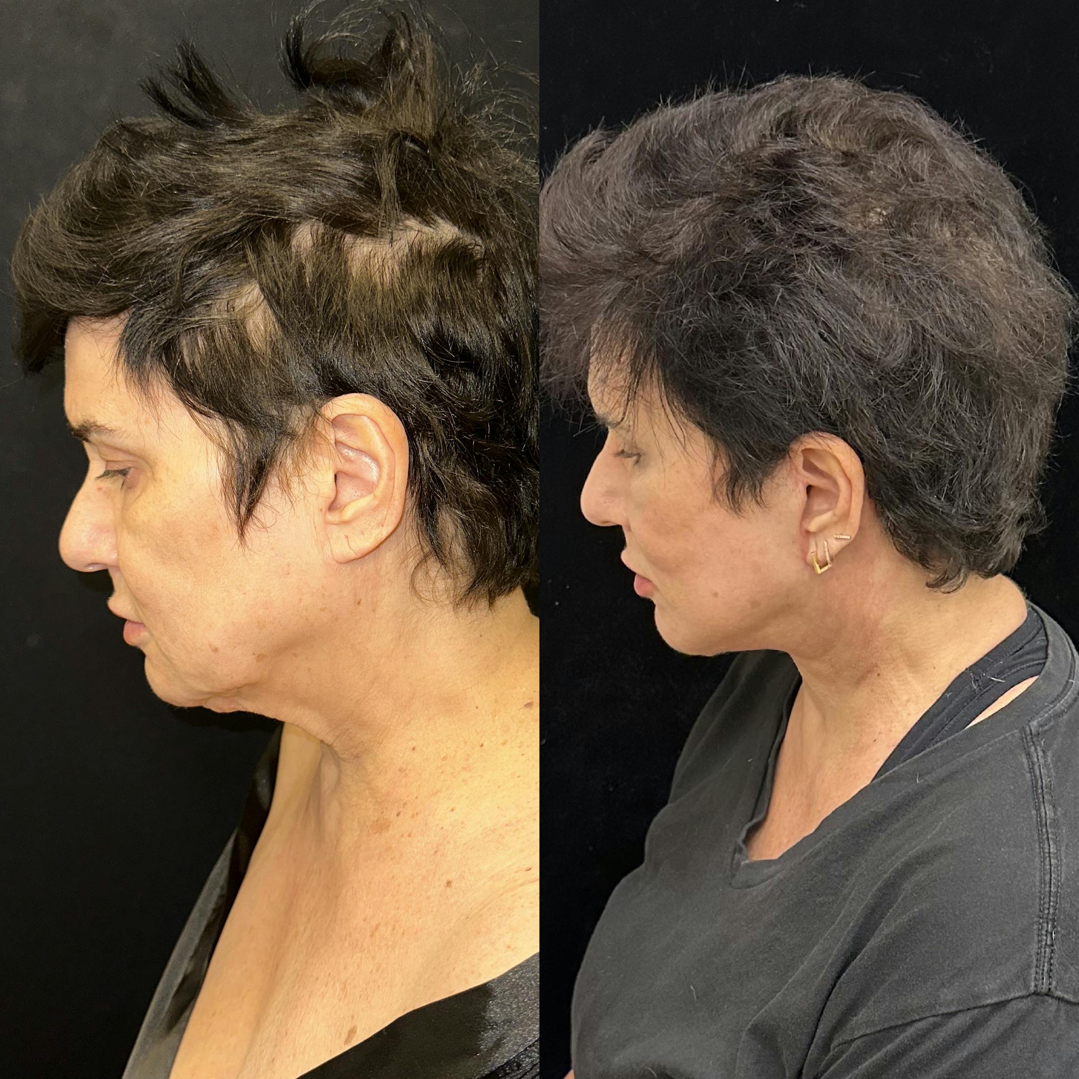 Deep Plane Facelift Before & After Gallery - Patient 283351 - Image 5