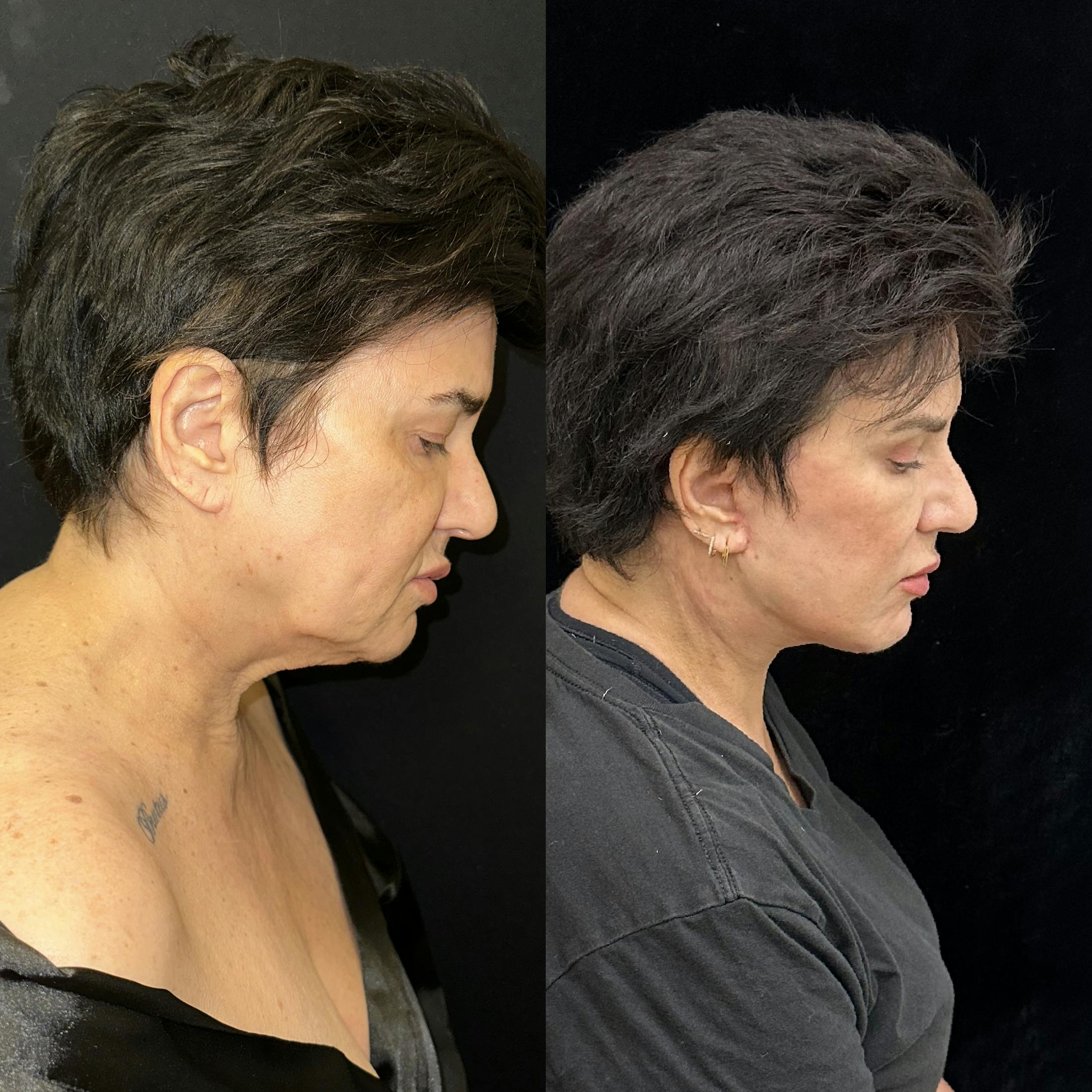 Deep Plane Facelift Before & After Gallery - Patient 283351 - Image 3