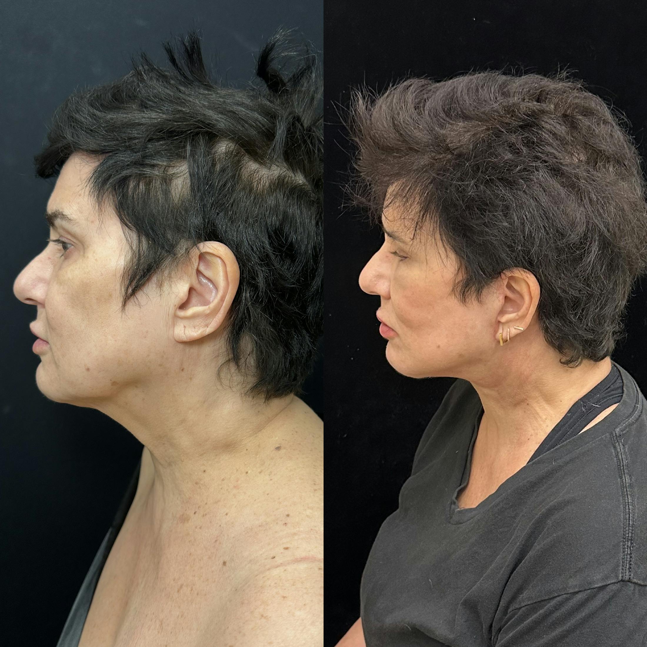 Deep Plane Facelift Before & After Gallery - Patient 283351 - Image 4