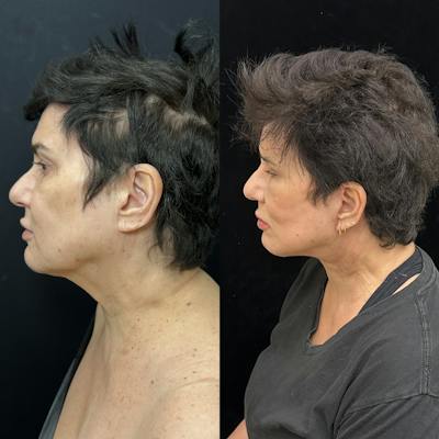 Deep Plane Facelift Before & After Gallery - Patient 283351 - Image 4