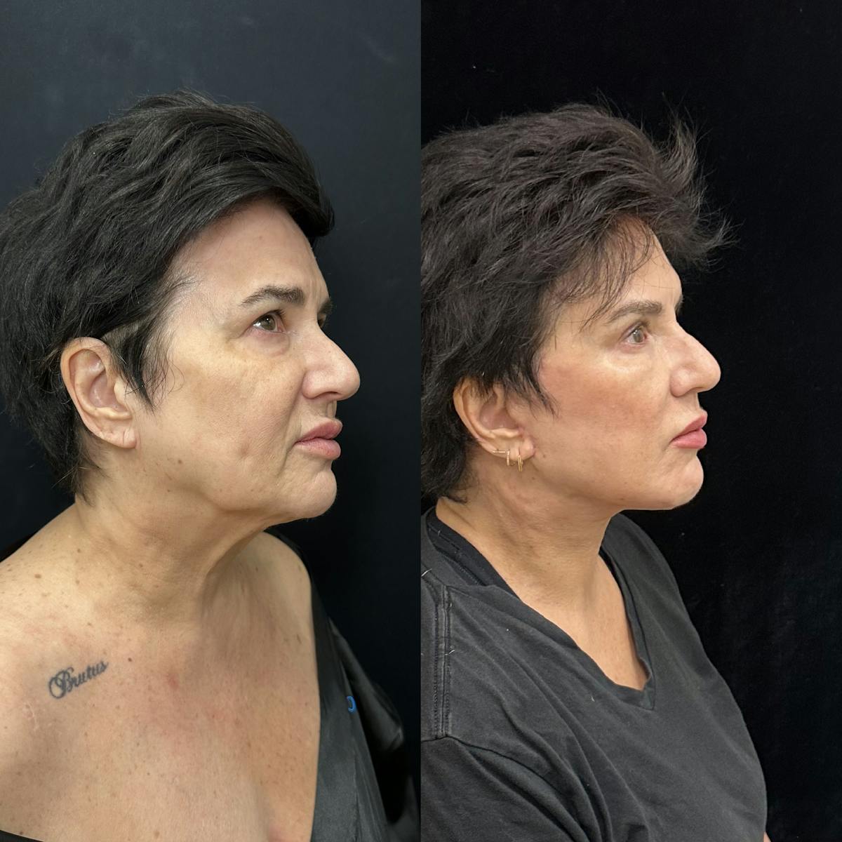 Deep Plane Facelift Before & After Gallery - Patient 283351 - Image 2