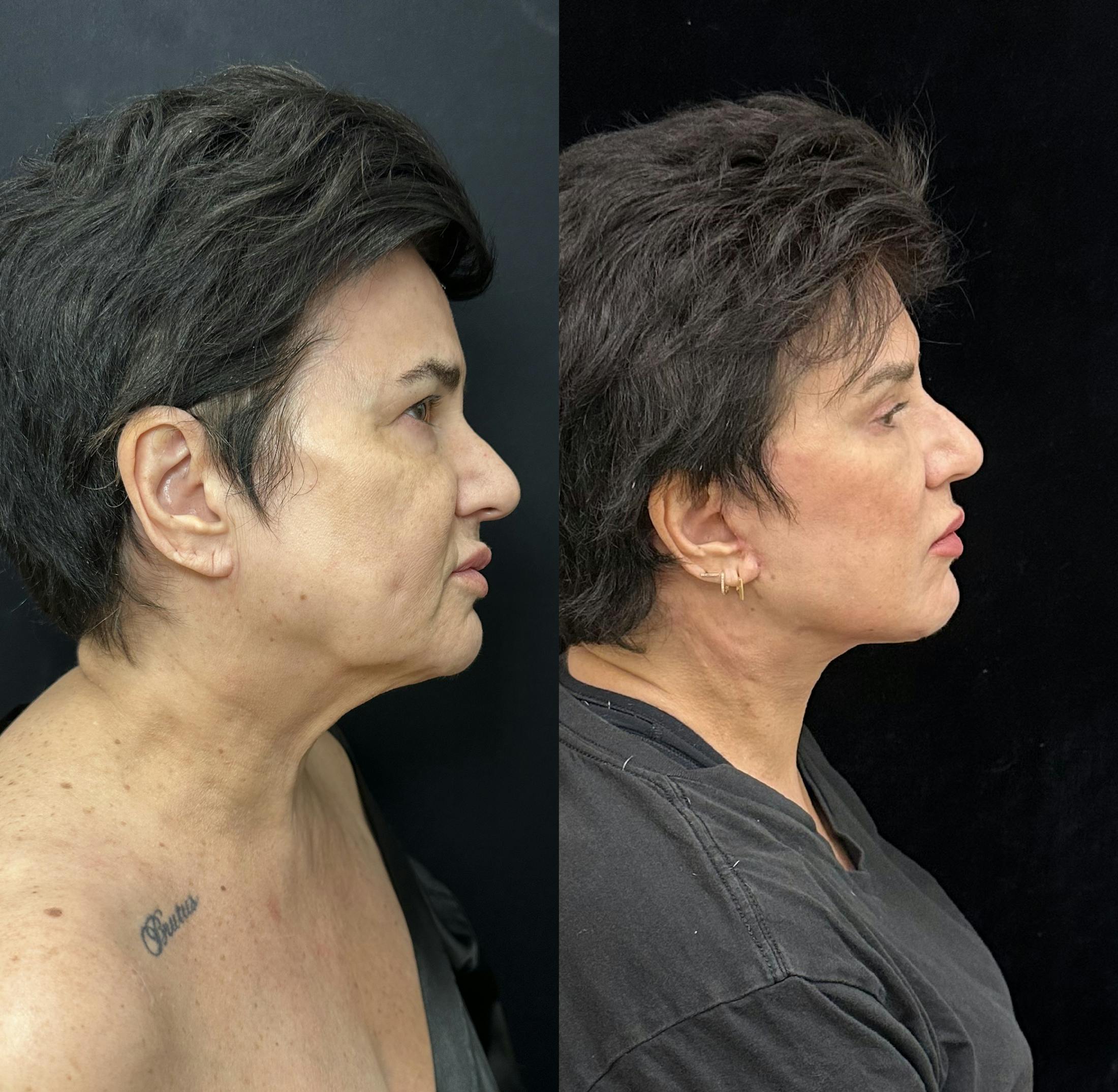 Deep Plane Facelift Before & After Gallery - Patient 283351 - Image 1