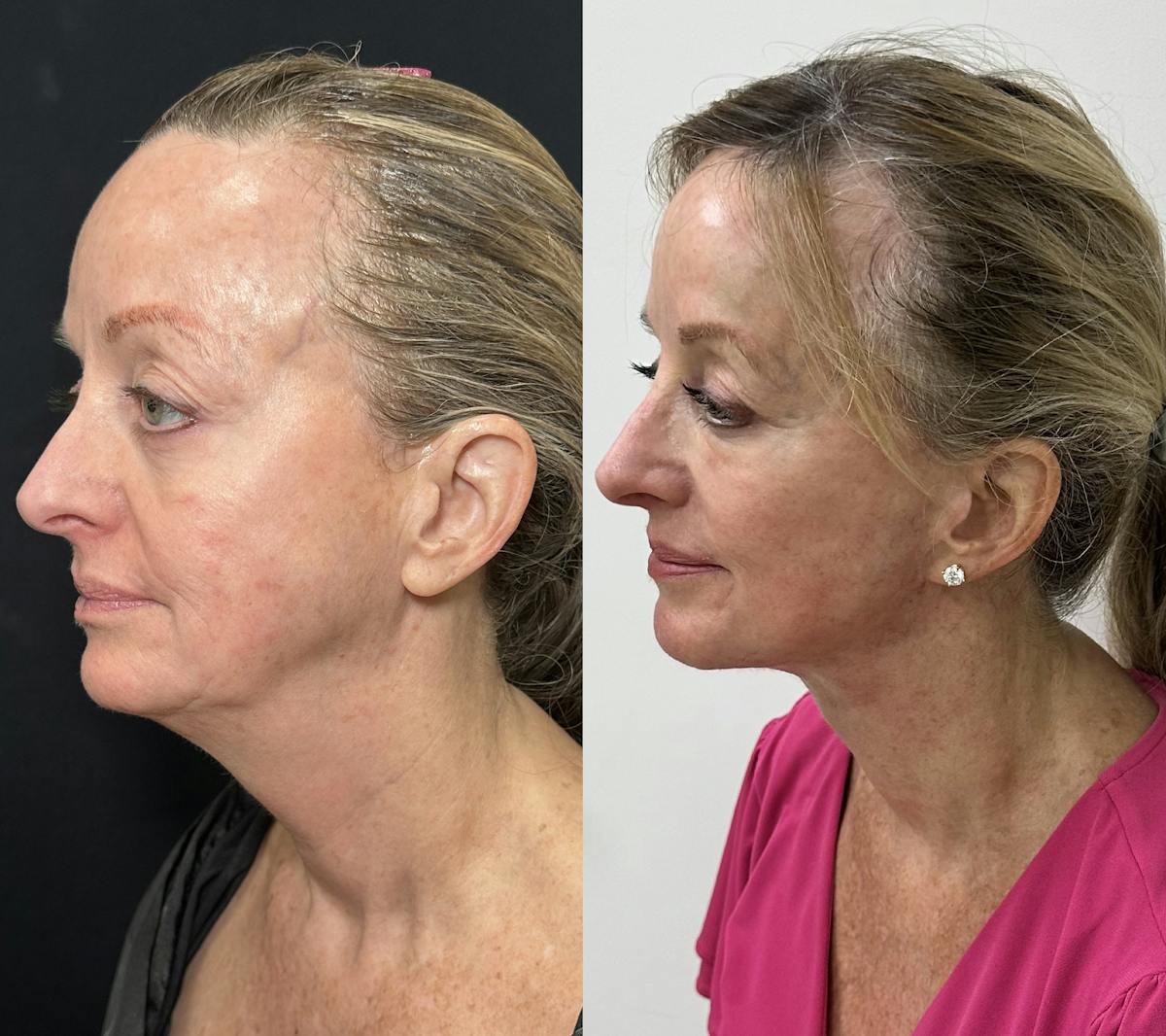 Deep Plane Facelift Before & After Gallery - Patient 398326 - Image 4
