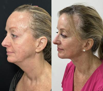 Deep Plane Facelift Before & After Gallery - Patient 398326 - Image 4