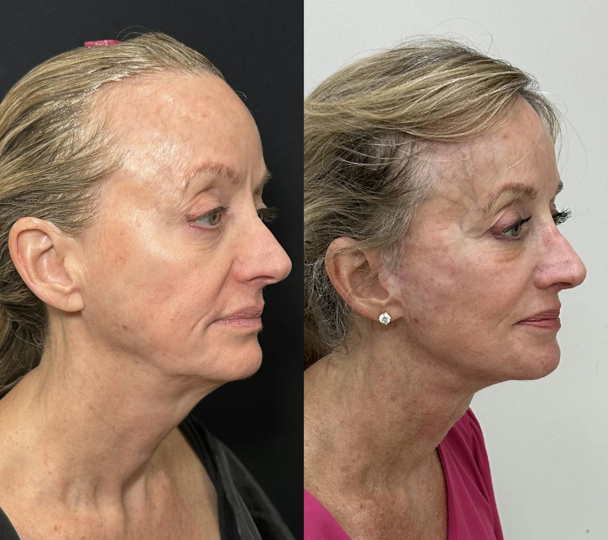 Deep Plane Facelift Before & After Gallery - Patient 398326 - Image 1