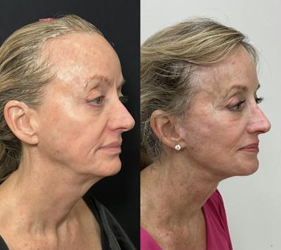 Deep Plane Facelift Before & After Gallery - Patient 398326 - Image 1