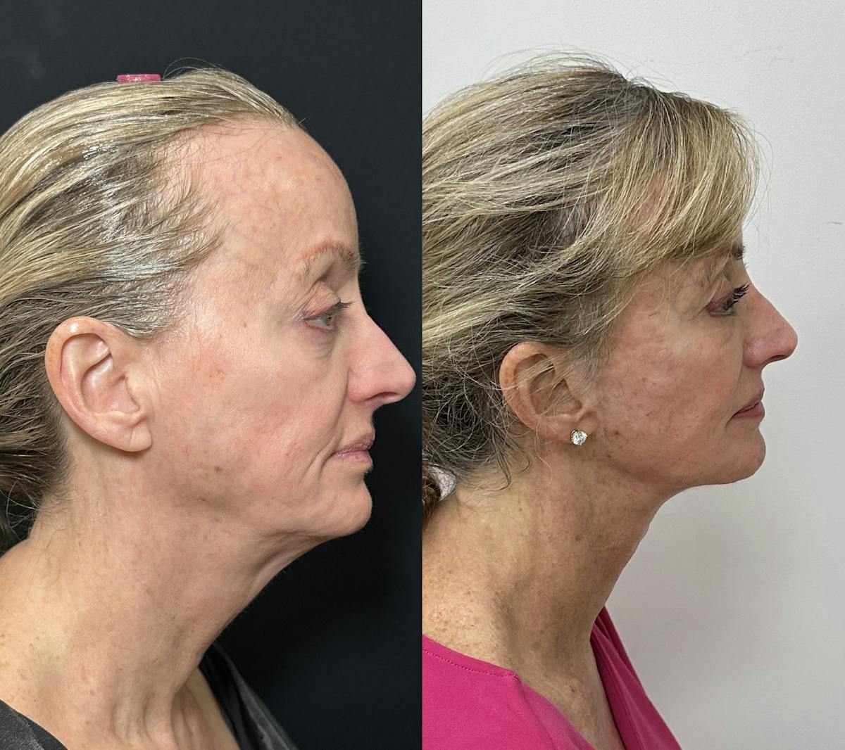 Deep Plane Facelift Before & After Gallery - Patient 398326 - Image 2