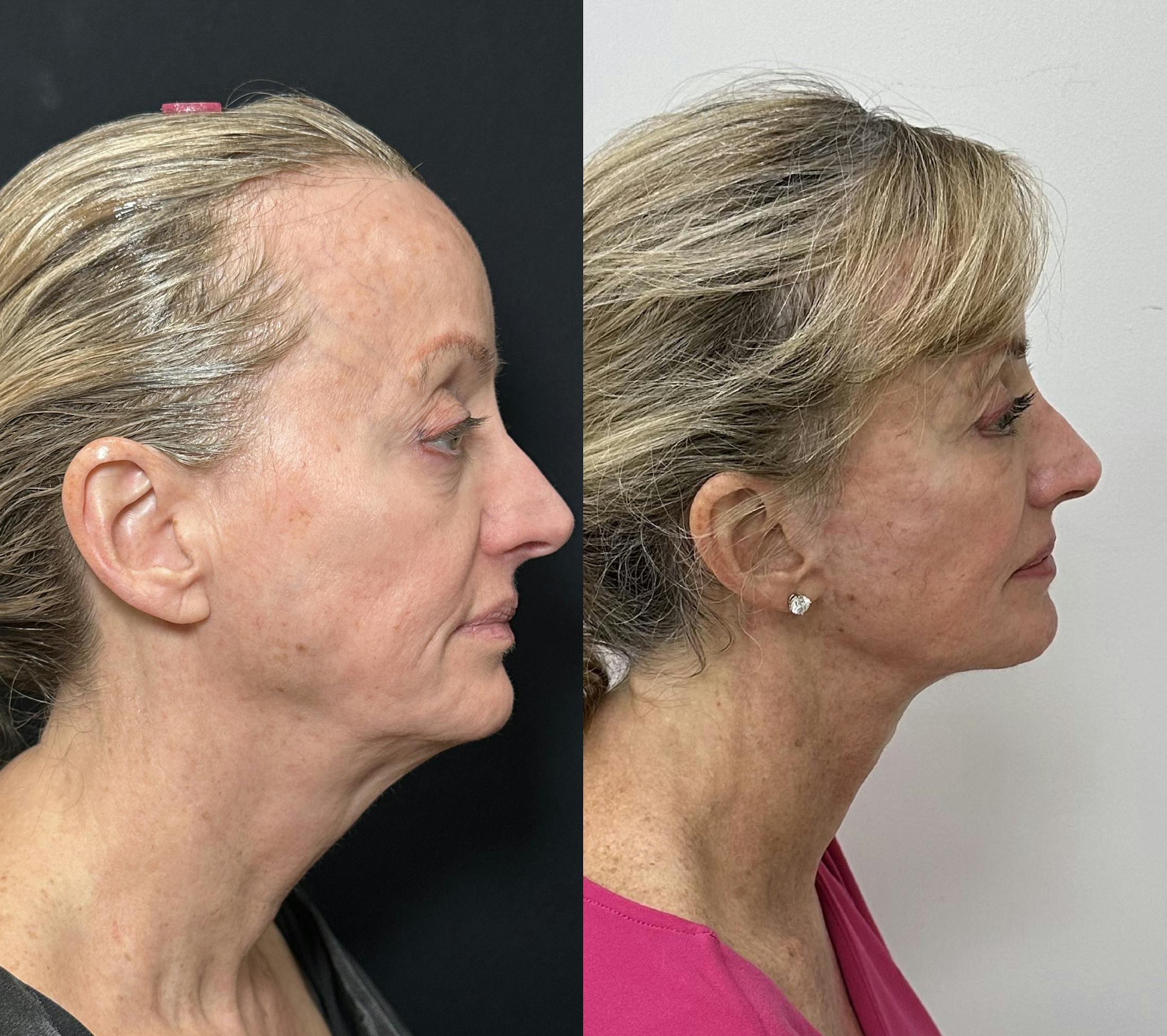 Deep Plane Facelift Before & After Gallery - Patient 398326 - Image 2