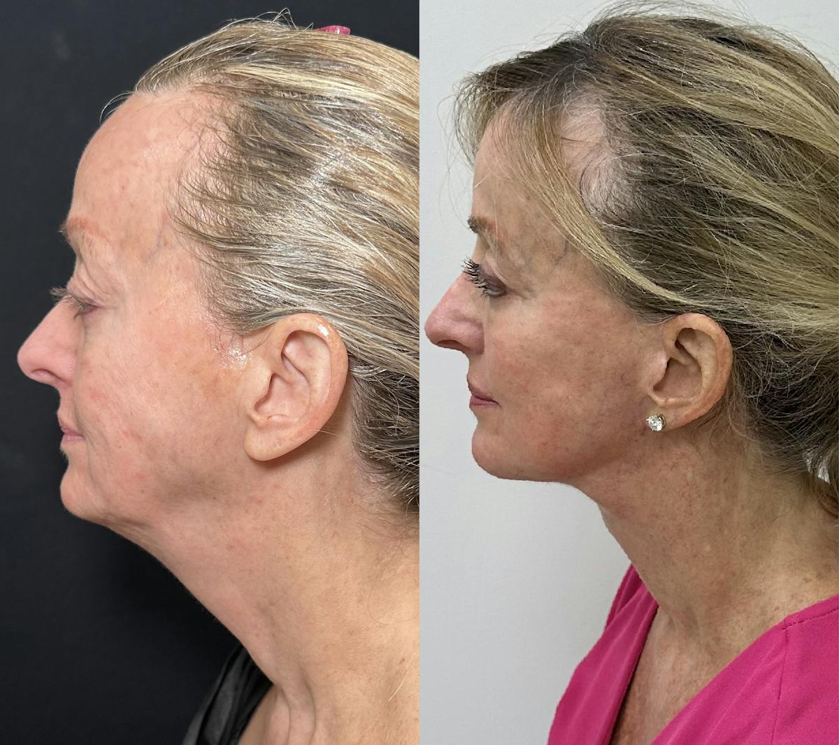 Deep Plane Facelift Before & After Gallery - Patient 398326 - Image 3
