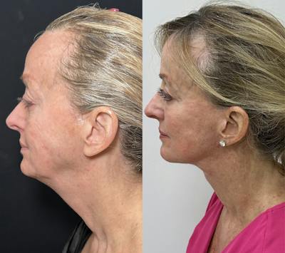 Deep Plane Facelift Before & After Gallery - Patient 398326 - Image 3
