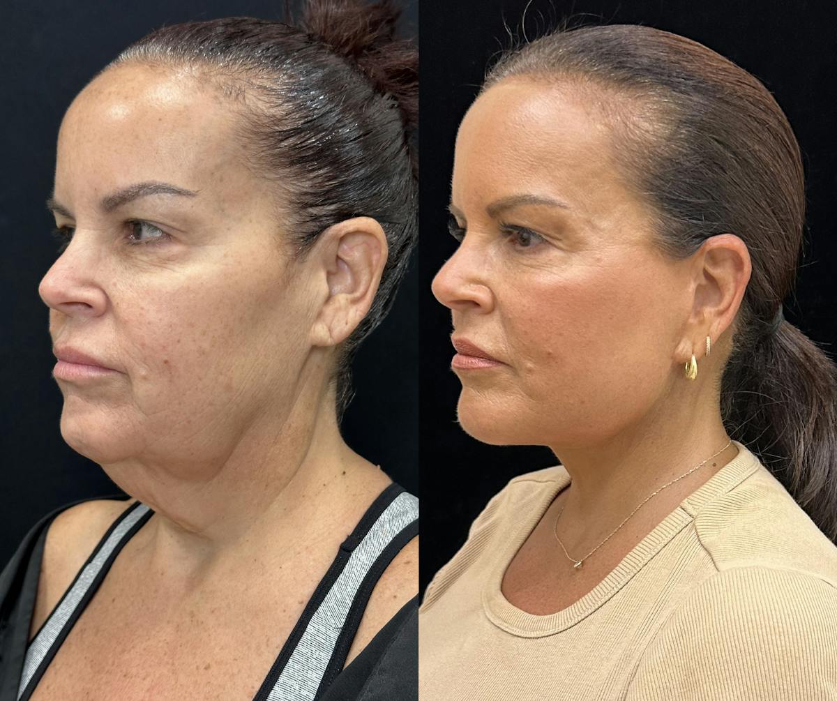Deep Plane Facelift Before & After Gallery - Patient 312060 - Image 1