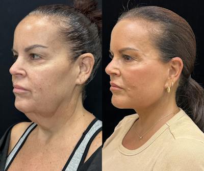 Deep Plane Facelift Before & After Gallery - Patient 312060 - Image 1