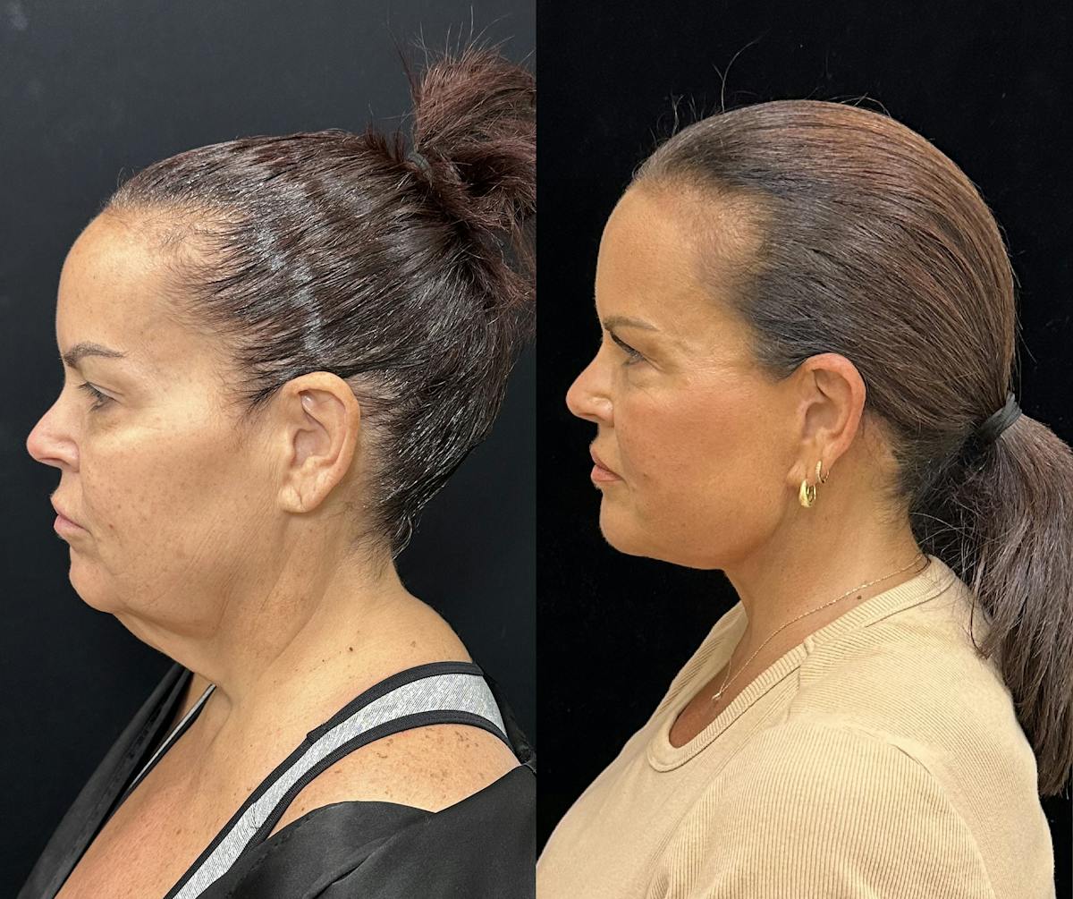 Deep Plane Facelift Before & After Gallery - Patient 312060 - Image 2