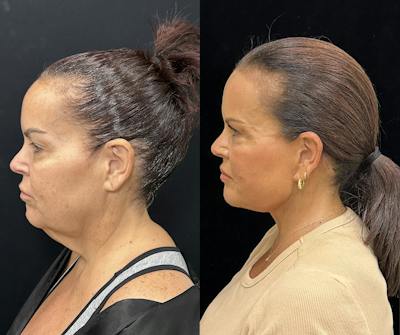 Deep Plane Facelift Before & After Gallery - Patient 312060 - Image 2