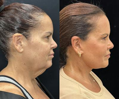 Deep Plane Facelift Before & After Gallery - Patient 312060 - Image 4