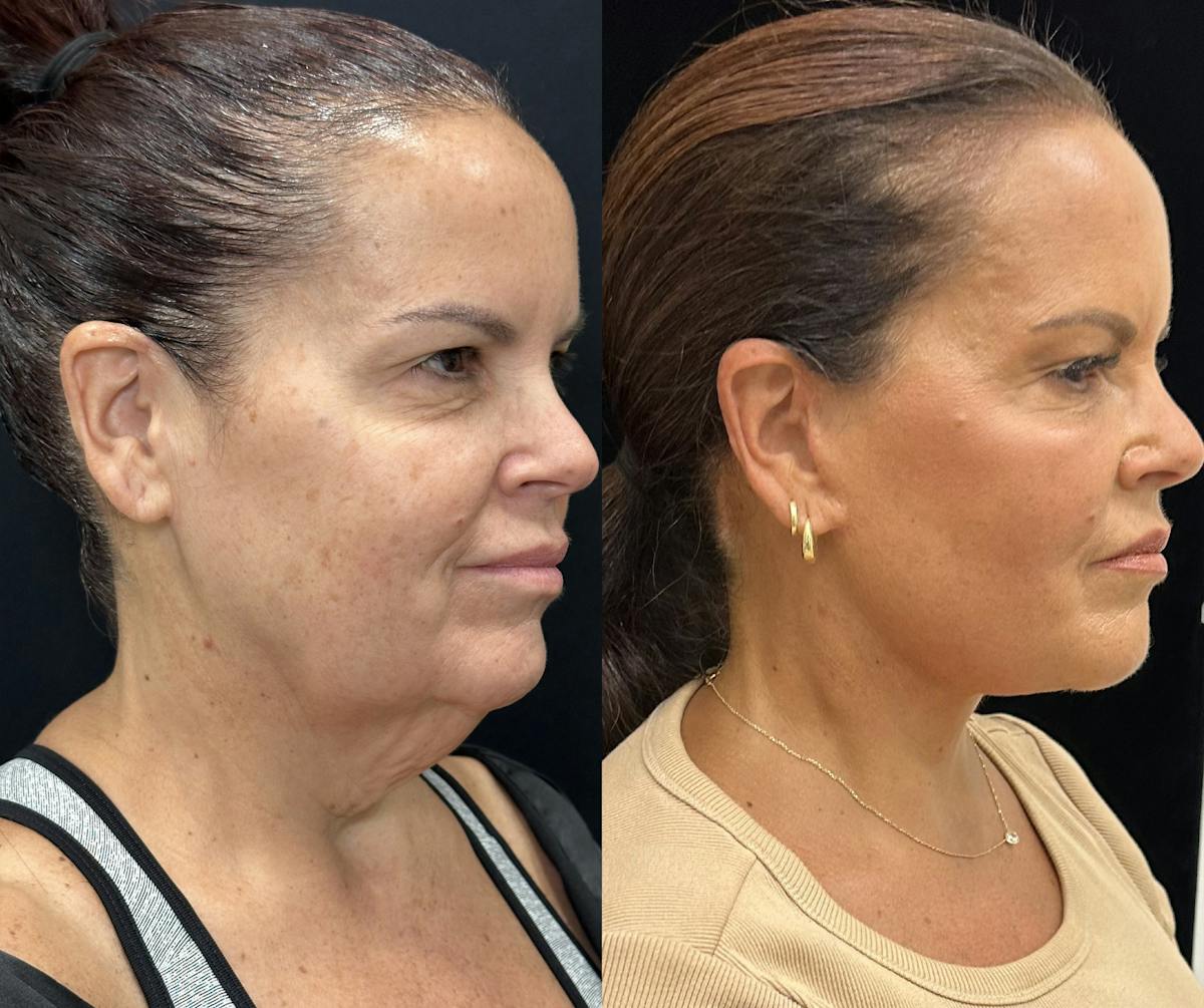Deep Plane Facelift Before & After Gallery - Patient 312060 - Image 3