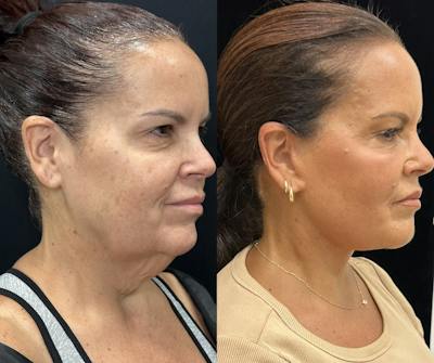 Deep Plane Facelift Before & After Gallery - Patient 312060 - Image 3