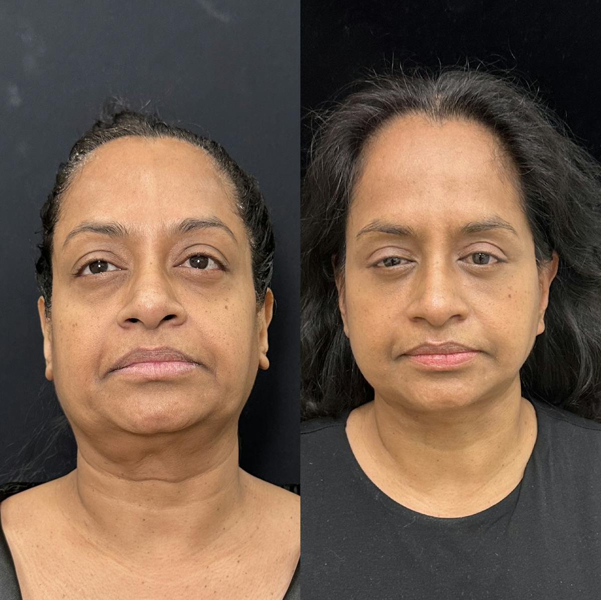 Deep Plane Facelift Before & After Gallery - Patient 322272 - Image 1
