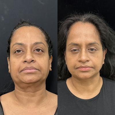 Deep Plane Facelift Before & After Gallery - Patient 322272 - Image 1
