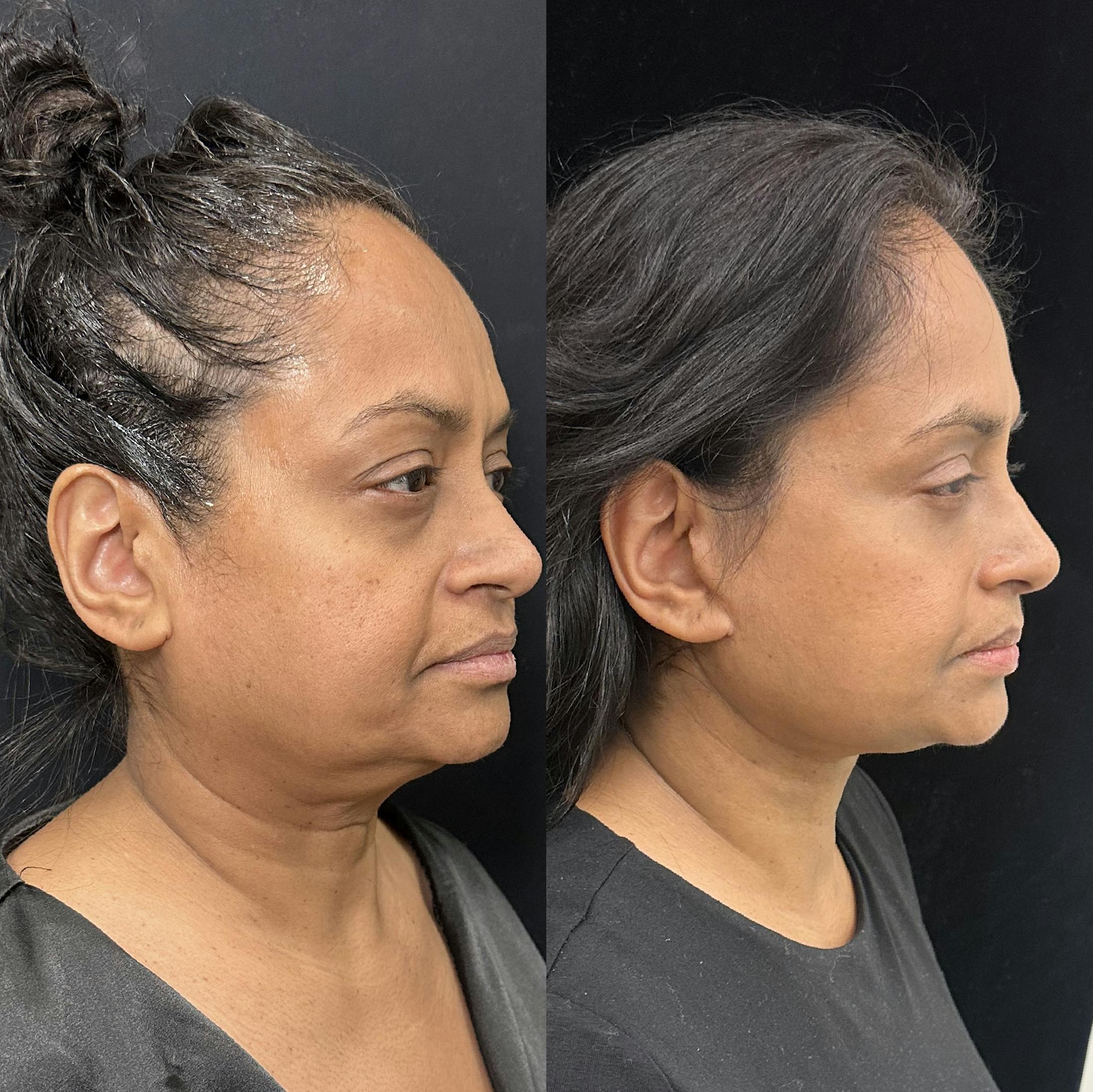Deep Plane Facelift Before & After Gallery - Patient 322272 - Image 2