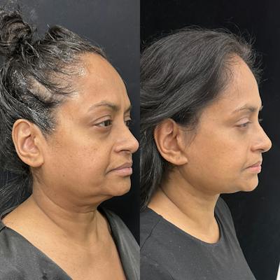 Deep Plane Facelift Before & After Gallery - Patient 322272 - Image 2
