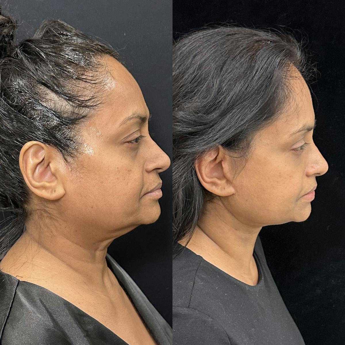 Deep Plane Facelift Before & After Gallery - Patient 322272 - Image 3